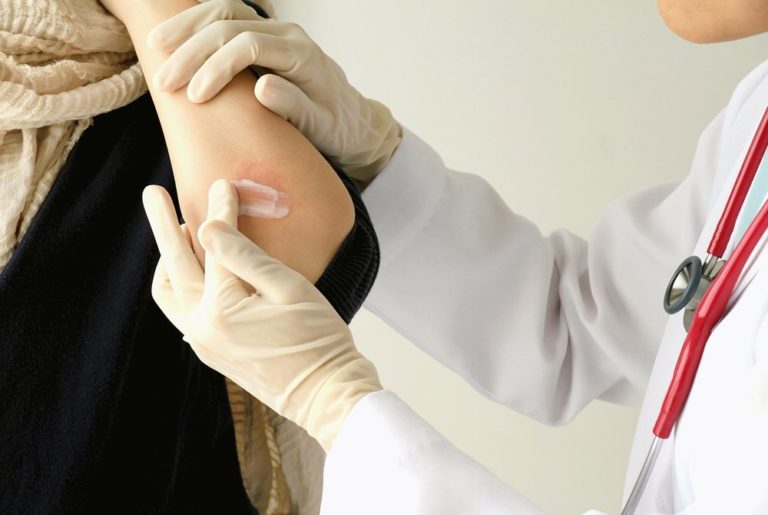Treatment of Minor Burns or Skin Irritations